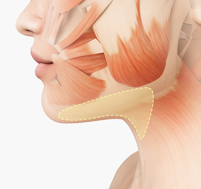 다양한 이중턱의 원인 - 활경근 속 지방 패드 비대