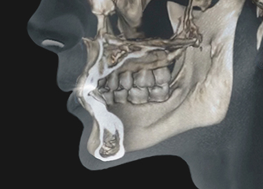이중턱 근육묶기 수술 방법 - step1 CT 정밀 진단 & 디자인