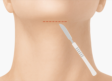 이중턱 근육묶기 수술 방법 - step2 최소 절개 후 박리