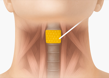 이중턱 근육묶기 수술 방법 - step3 목근육 속지방 지방 제거 + 목근육 묶기